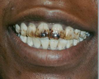 Original photograph illustrating dental fluorosis